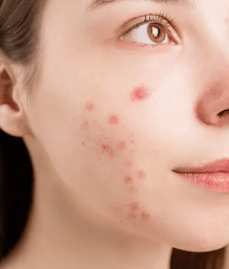 using too many acne treatments